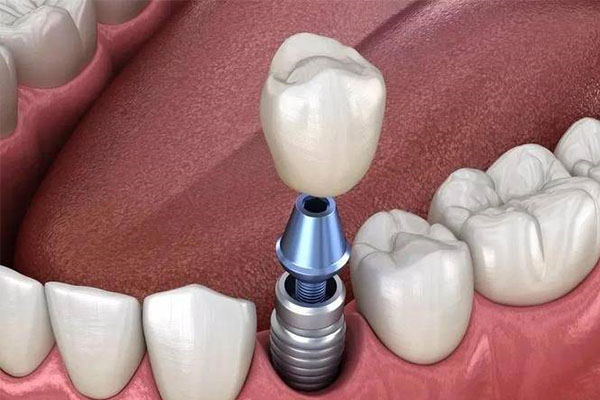 南京种牙哪家好？中老年口腔批量种