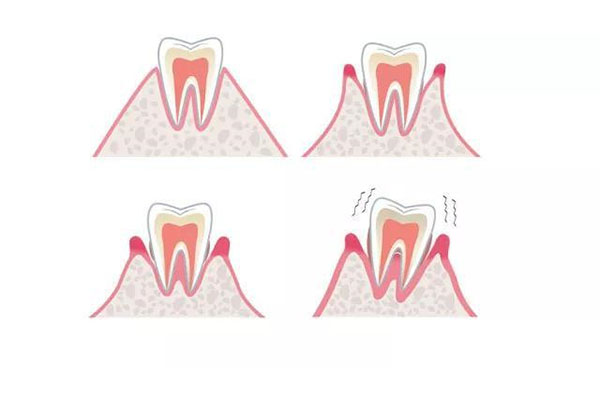 中老年人牙齿松动疼痛别慌，这样处