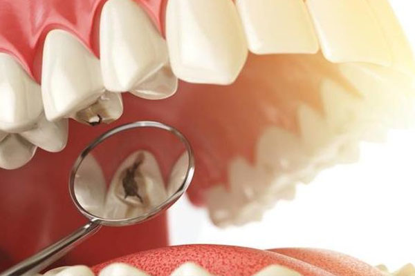 成人烂牙补还是拔？中老年口腔专家