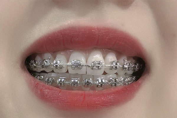 中老年口腔高效护理：牙齿活动矫正