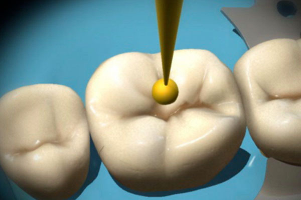 小孩牙齿涂氟价格贵吗？中老年口腔带您了解涂氟费用及注意事