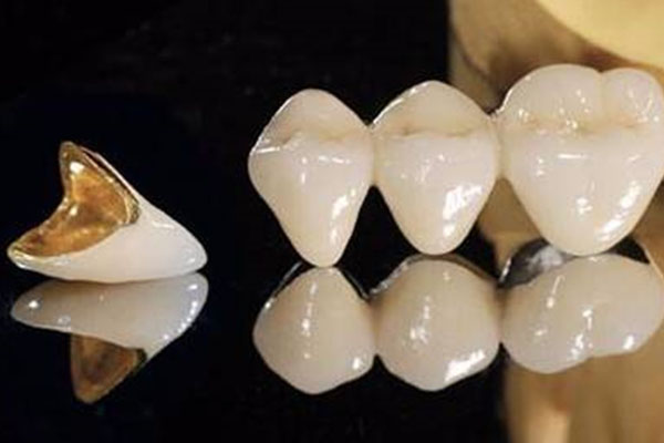 假牙桥体总塞牙？中老年口腔卫生桥