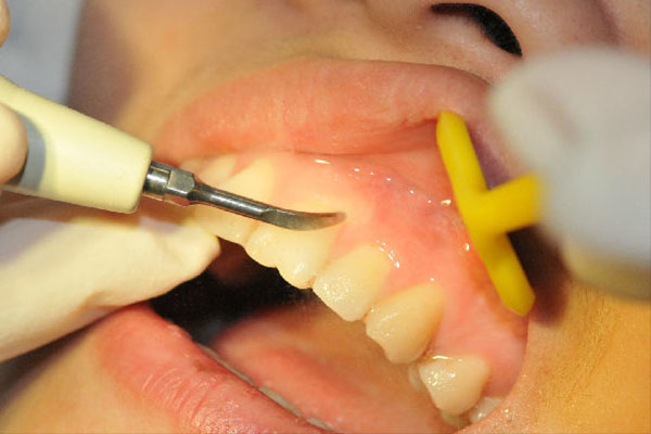 洗牙价格高？中老年口腔为您推荐经