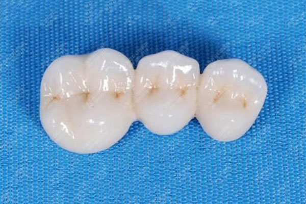 800元一颗的全瓷牙真的靠谱吗？中老