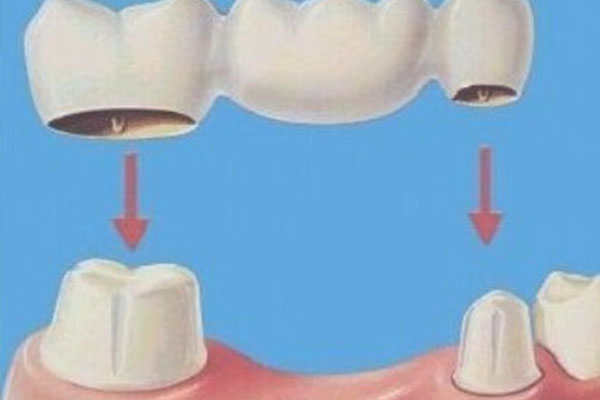 在深圳镶牙多少钱一颗啊？揭秘中老