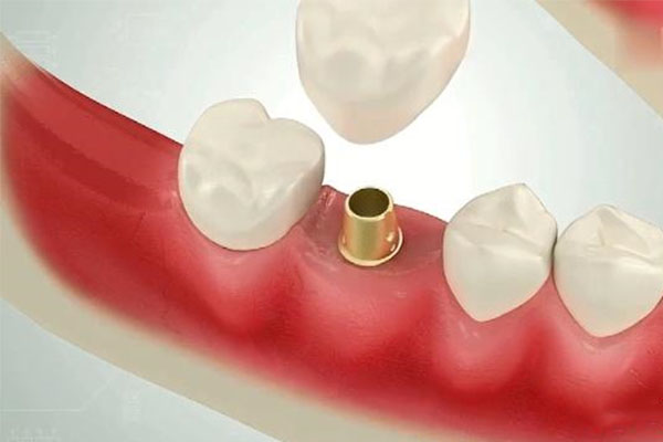 种牙的过程是不是很遭罪？中老年口