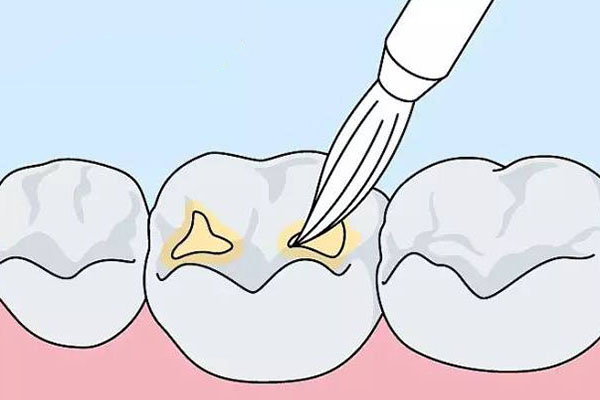 牙科涂氟操作：中老年口腔日常护理的简便高效方案