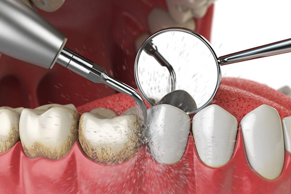 洗牙后牙根暴露怎么办？中老年口腔为您解决牙结石困扰