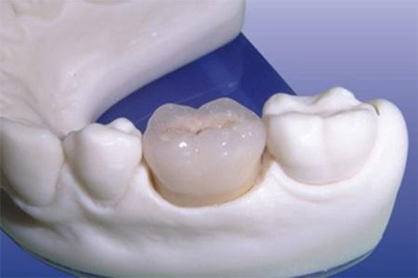 补牙材料Z350和Z250的区别，中老年口腔为您详解哪种更适合缺牙