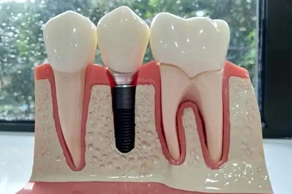 种牙一般要去医院几次 实际流程是怎