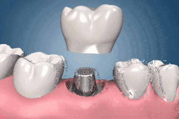 老人种牙有什么风险和危害？中老年