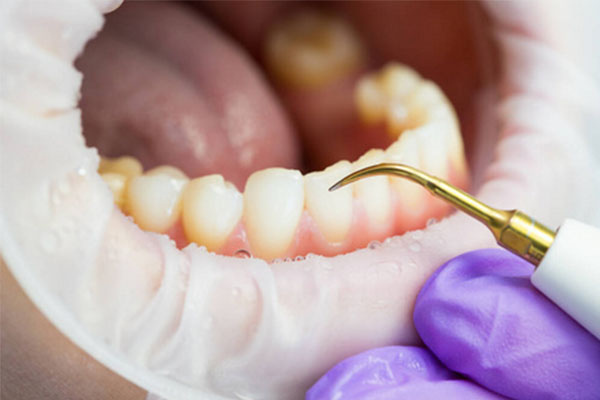 九院洗牙价格对比：中老年朋友看过