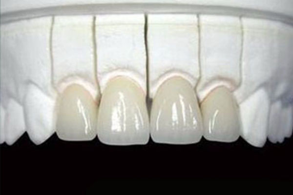 牙冠怎么用才能更省心？中老年口腔