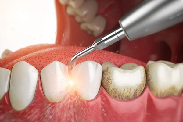 洗牙危害大揭秘！中老年口腔为您护航健康晚年