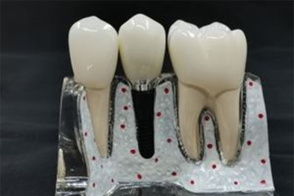 广州种牙价格多少？中老年口腔真实案例告诉你单颗收费的秘密