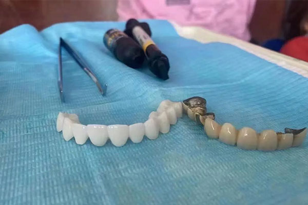 牙冠戴上多久能正常吃饭？中老年口