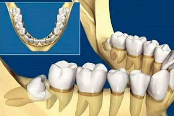 拔智齿医保可以报销吗大学生
