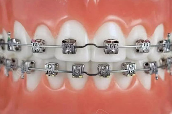 广州牙齿矫正收费贵吗？中老年口腔为您解答矫正效果与价格的