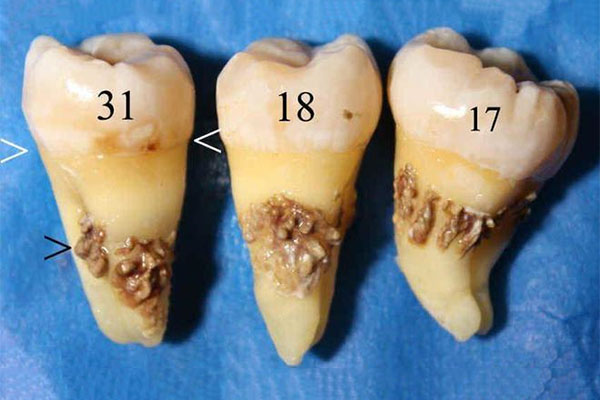 拔智齿有残根没拔干净怎么办？中老
