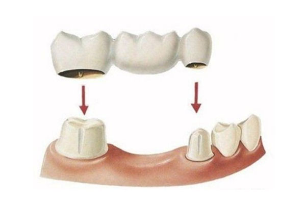 缺多颗牙如何镶牙？中老年口腔批量