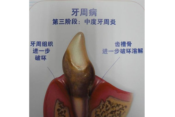 牙周炎真的普遍存在吗？中老年口腔