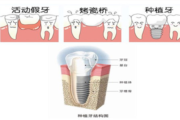 瑞士种牙价格一般多少钱一颗啊