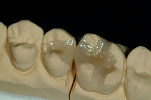 烤瓷牙套价格亲民吗？中老年口腔为