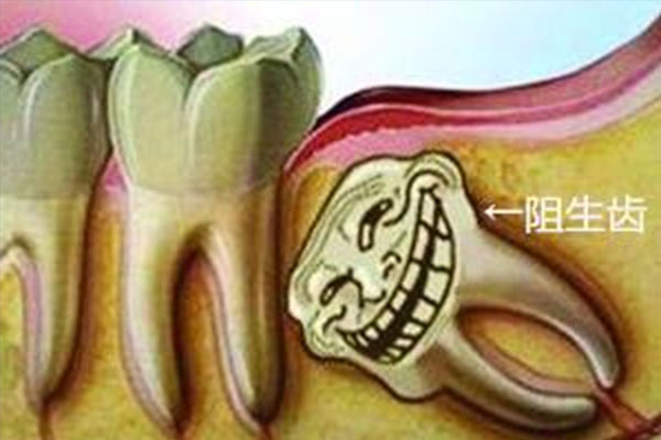 杭州拔颗智齿需要多少钱？中老年口