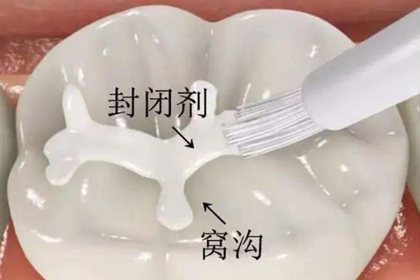 牙齿涂氟的好处与坏处，中老年口腔健康必看！