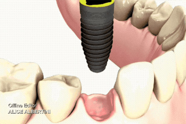 北京种牙医保能报销吗？中老年口腔