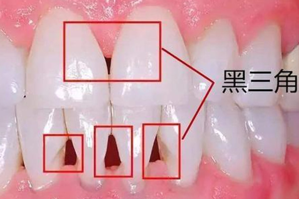 年轻人牙龈萎缩是什么原因造成的中医调理(年轻人牙龈萎缩是什