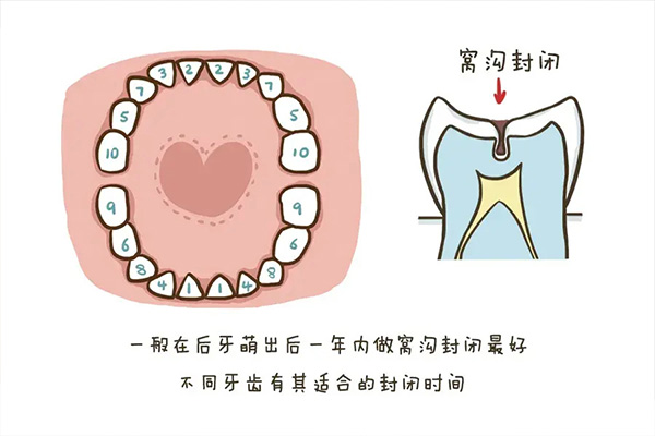 儿童换牙后需要做窝沟封闭吗(小孩换