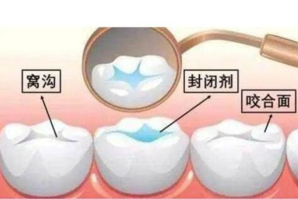 儿童牙齿做窝沟封闭挂什么科(儿童做窝沟封闭挂哪个科)