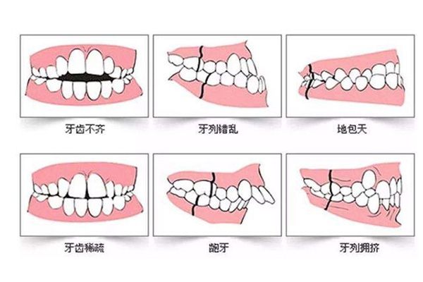 龅牙和龅牙有什么区别(龇牙和呲牙的意思)