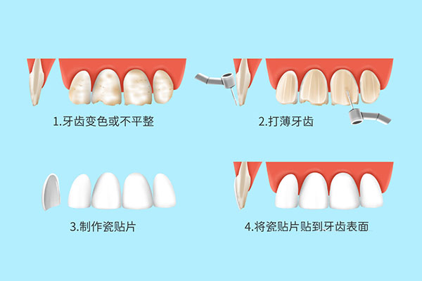 牙贴面做完后有缝隙怎么办(牙贴面做
