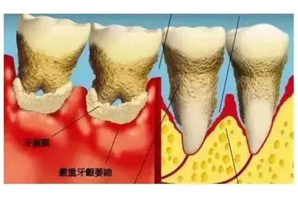 怎么改善牙龈萎缩牙缝变大(怎么改善