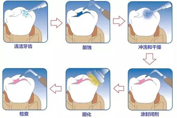 儿童封闭窝沟有必要做吗(学校免费做窝沟封闭猫腻)