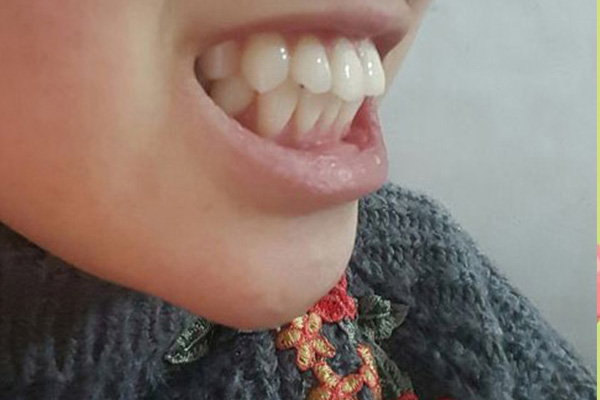 地包天手术多久可以正常吃饭(做完地包天手术)