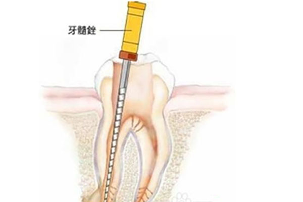 做牙根管治疗的费用可以医保报销吗