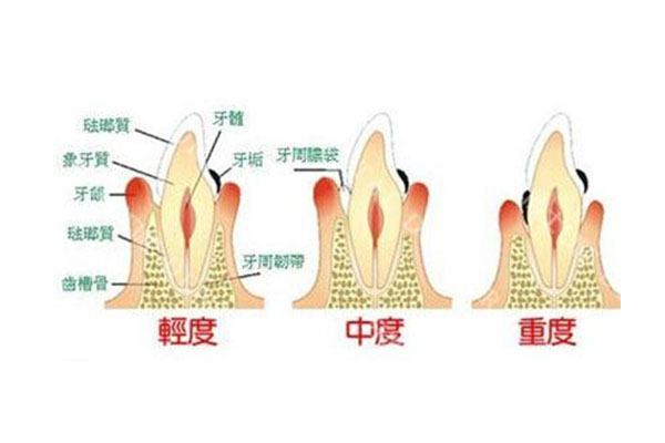 严重蛀牙修复(严重蛀牙修复要多少钱)