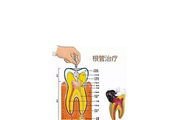 做根管治疗要多久才能种牙(做根管治