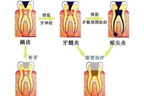 做过根管治疗的牙还能补吗(做过根管治疗还能整牙吗)