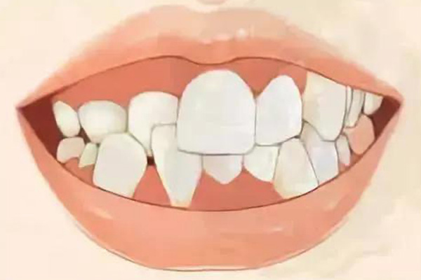 龅牙如何内收(龅牙怎么收)