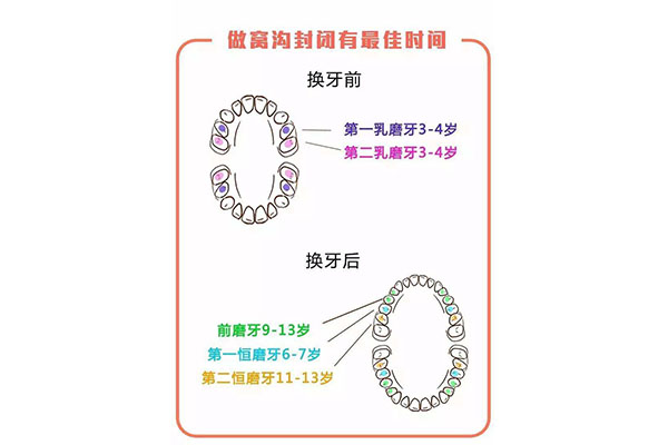 儿童牙齿窝沟封闭一次可以完成吗多少钱(儿童牙齿窝沟封闭一次