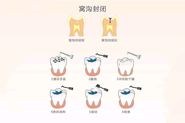 儿童牙齿做窝沟封闭多少钱一次啊(儿童牙齿做窝沟封闭多少钱一