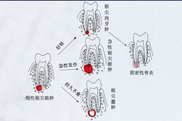小孩根尖炎治疗需要多少钱(小孩根尖
