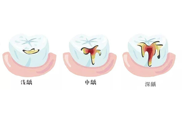 两岁孩子蛀牙怎么治疗好呢(两岁孩子
