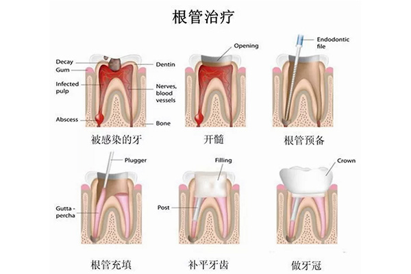 做根管治疗的步骤(做根管治疗的步骤图解)