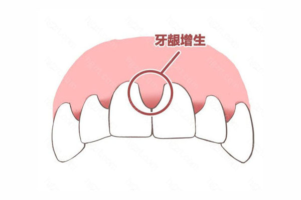 巴氏刷牙把牙龈刷萎缩了怎么办啊(巴氏刷牙把牙龈刷萎缩了怎么