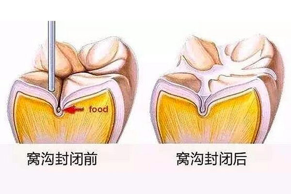 儿童多大窝沟封闭(小孩多大窝沟封闭